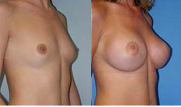 breast augmentation tunisia, breast enlargement tunisia